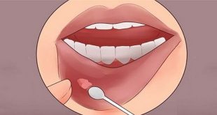 درمان قطعی آفت دهان