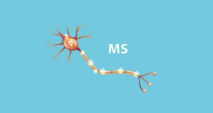 علائم بیماری MS در زنان