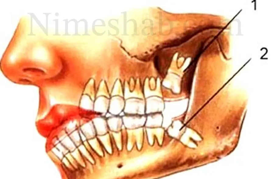 هر آنچه که باید در مورد دندان عقل و کشیدن آن بدانید
