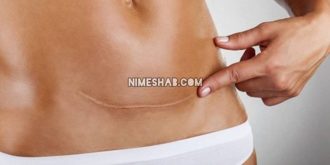 نگهداری از بخیه سزارین