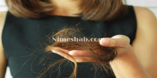 ریزش مو بعد از کرونا
