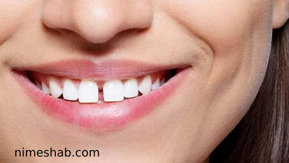 فاصله بین دندان‌ها یک ویژگی آزاردهنده بدنی نیست! 