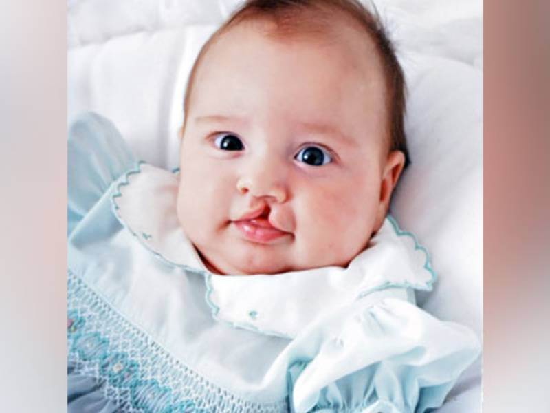 علت های پنهان بچه های لب شکری و جلوگیری از آن نیمه شب مجله علمی هنری